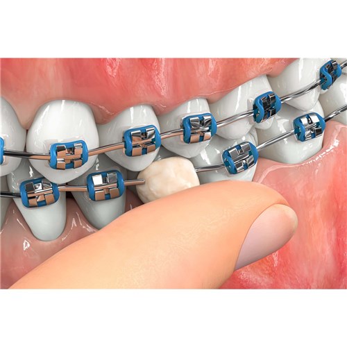 Gishy Goo! Silicone Bracket Relief Aid 5ml Syringe x 10 pk