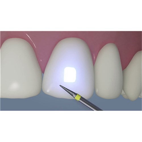 AlignerFlow LC A2 Syringe 2x2g for Aligner Attachments